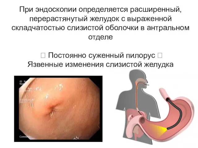 При эндоскопии определяется расширенный, перерастянутый желудок с выраженной складчатостью слизистой оболочки