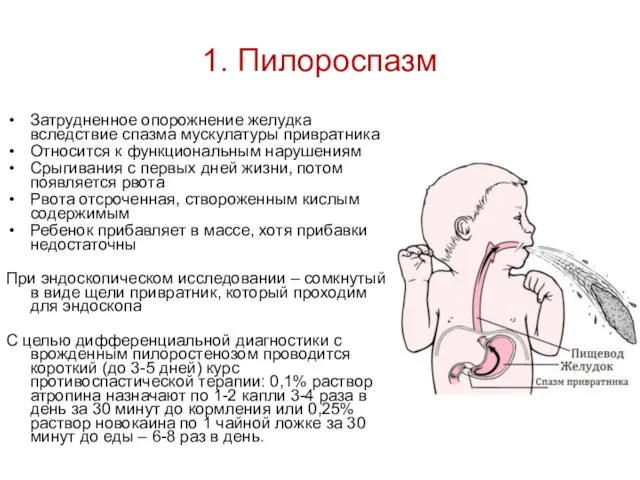 1. Пилороспазм Затрудненное опорожнение желудка вследствие спазма мускулатуры привратника Относится к