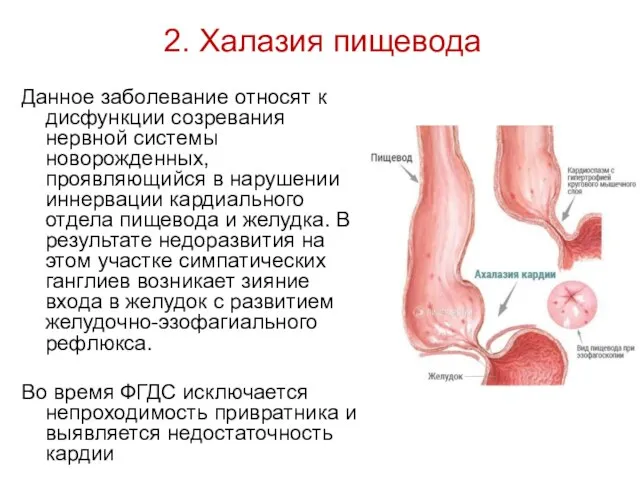 2. Халазия пищевода Данное заболевание относят к дисфункции созревания нервной системы