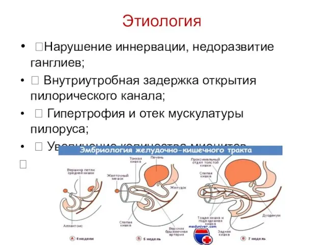 Этиология Нарушение иннервации, недоразвитие ганглиев;  Внутриутробная задержка открытия пилорического канала;