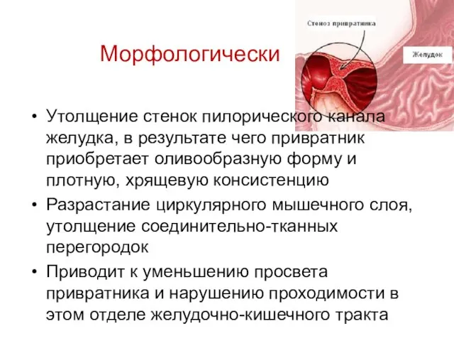 Морфологически Утолщение стенок пилорического канала желудка, в результате чего привратник приобретает