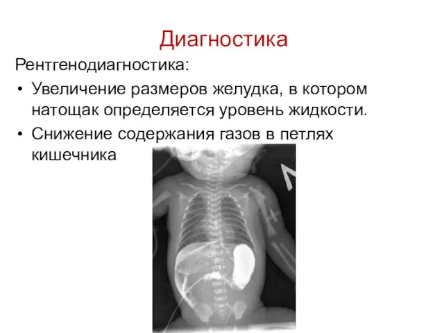 Диагностика Рентгенодиагностика: Увеличение размеров желудка, в котором натощак определяется уровень жидкости.