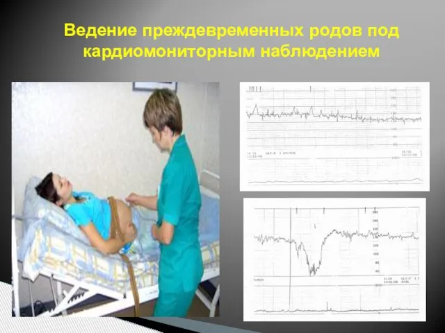 Ведение преждевременных родов под кардиомониторным наблюдением