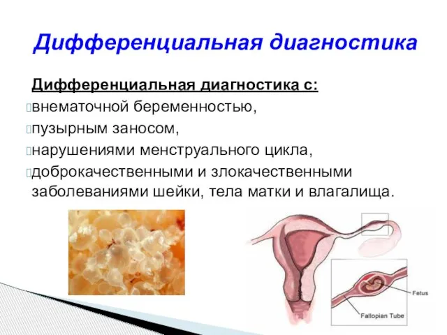 Дифференциальная диагностика с: внематочной беременностью, пузырным заносом, нарушениями менструального цикла, доброкачественными