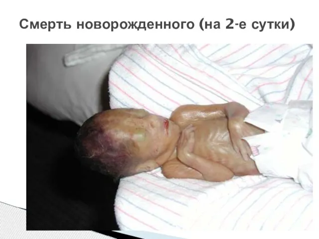 Смерть новорожденного (на 2-е сутки)