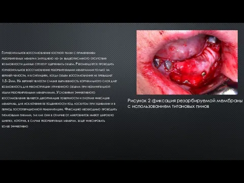 Горизонтальное восстановление костной ткани с применением резорбируемых мембран затруднено из‐за вышеописанного