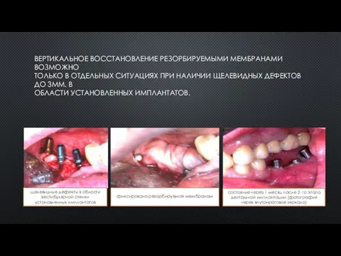 ВЕРТИКАЛЬНОЕ ВОССТАНОВЛЕНИЕ РЕЗОРБИРУЕМЫМИ МЕМБРАНАМИ ВОЗМОЖНО ТОЛЬКО В ОТДЕЛЬНЫХ СИТУАЦИЯХ ПРИ НАЛИЧИИ