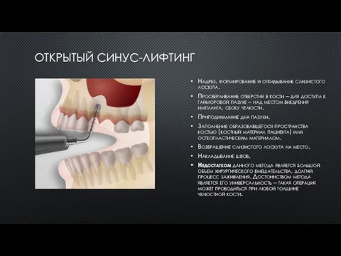 ОТКРЫТЫЙ СИНУС-ЛИФТИНГ Надрез, формирование и откидывание слизистого лоскута. Просверливание отверстия в