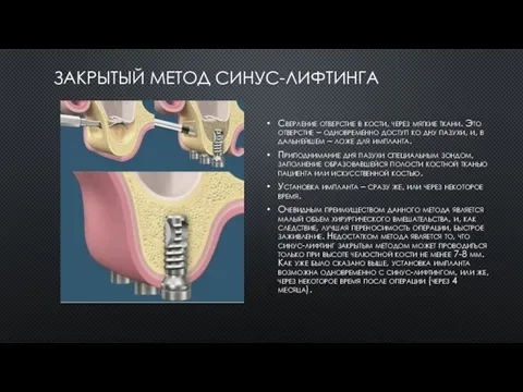 ЗАКРЫТЫЙ МЕТОД СИНУС-ЛИФТИНГА Сверление отверстие в кости, через мягкие ткани. Это