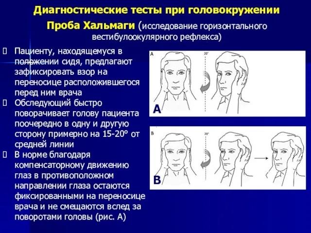 Диагностические тесты при головокружении Проба Хальмаги (исследование горизонтального вестибулоокулярного рефлекса) Пациенту,