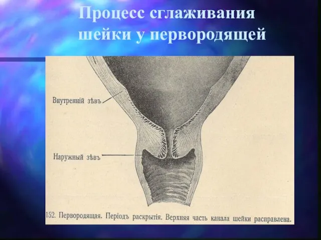 Процесс сглаживания шейки у первородящей