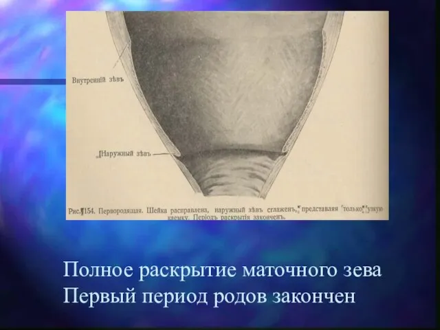 Полное раскрытие маточного зева Первый период родов закончен