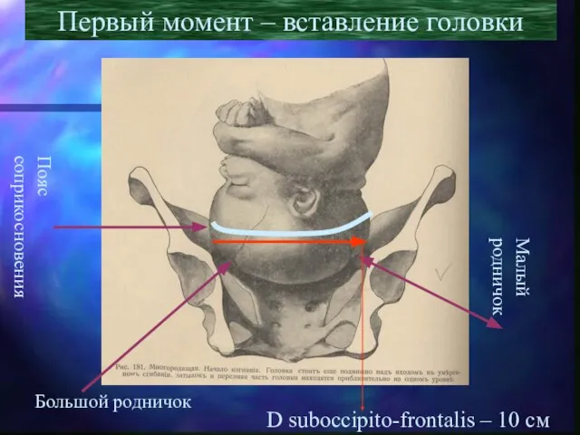 Первый момент – вставление головки Пояс соприкосновения Малый родничок Большой родничок D suboccipito-frontalis – 10 см