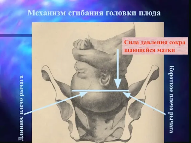 Механизм сгибания головки плода Длинное плечо рычага Короткое плечо рычага Сила давления сокра щающейся матки