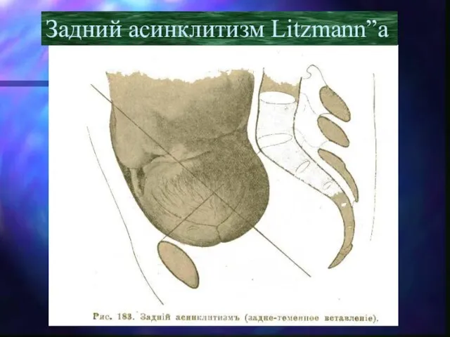 Задний асинклитизм Litzmann”a