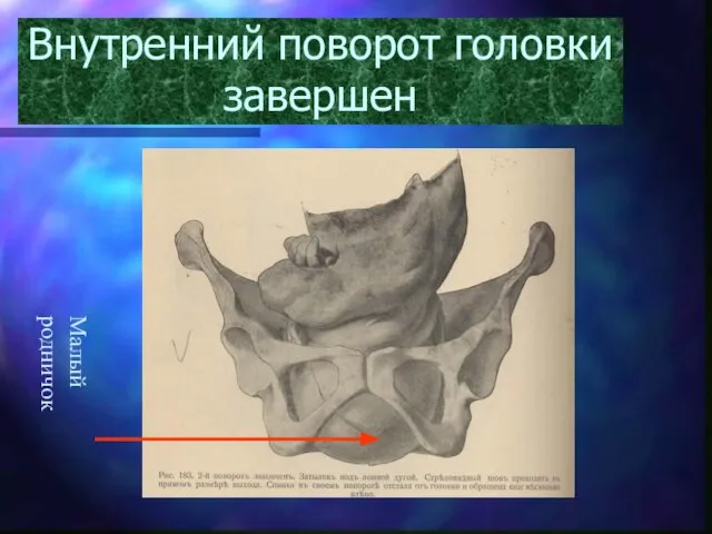 Внутренний поворот головки завершен Малый родничок