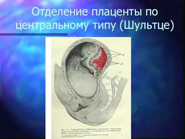 Отделение плаценты по центральному типу (Шультце)