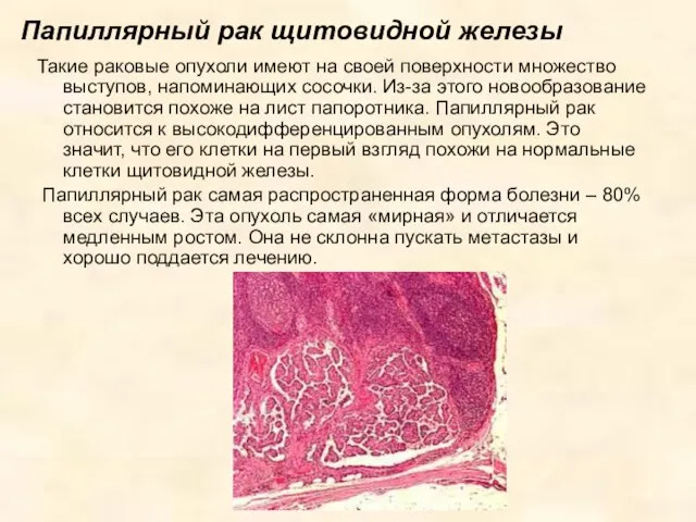 Папиллярный рак щитовидной железы Такие раковые опухоли имеют на своей поверхности