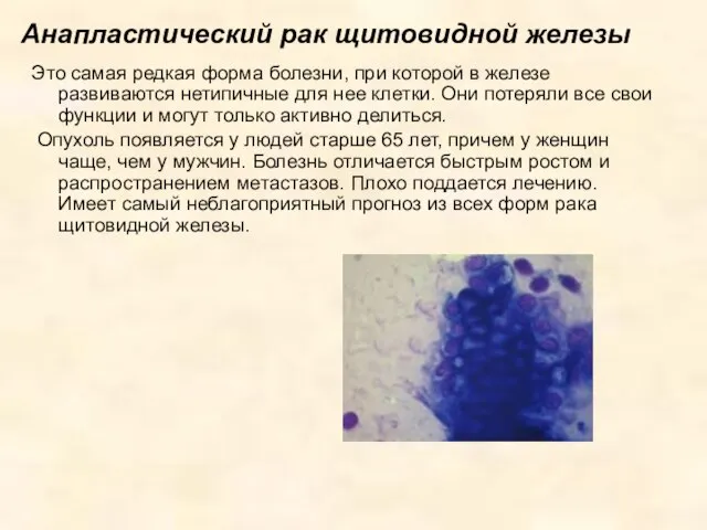 Анапластический рак щитовидной железы Это самая редкая форма болезни, при которой