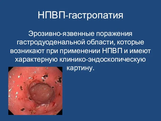 НПВП-гастропатия Эрозивно-язвенные поражения гастродуоденальной области, которые возникают при применении НПВП и имеют характерную клинико-эндоскопическую картину.