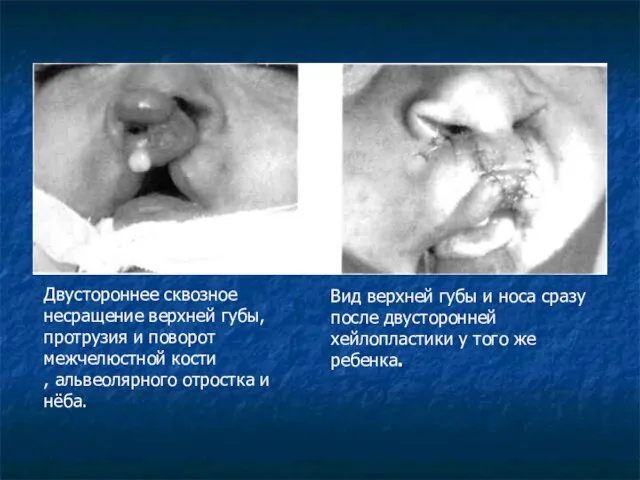 Двустороннее сквозное несращение верхней губы, протрузия и поворот межчелюстной кости ,