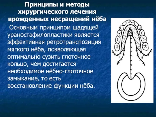 Принципы и методы хирургического лечения врожденных несращений нёба Основным принципом щадящей