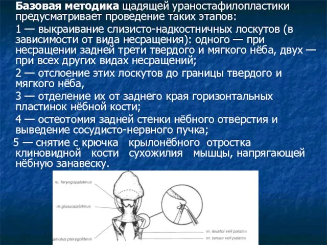 Базовая методика щадящей ураностафилопластики предусматривает проведение таких этапов: 1 — выкраивание