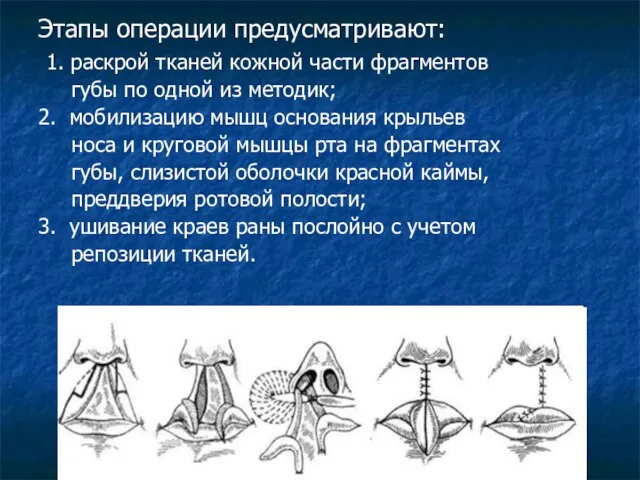 Этапы операции предусматривают: 1. раскрой тканей кожной части фрагментов губы по