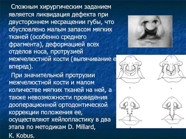 Сложным хирургическим заданием является ликвидация дефекта при двустороннем несращении губы, что