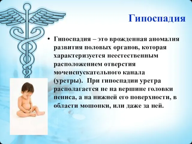 Гипоспадия Гипоспадия – это врожденная аномалия развития половых органов, которая характеризуется