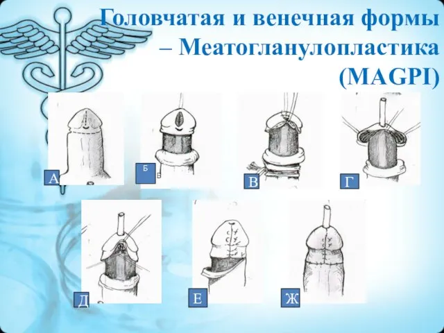 А Б Б В Г Д Е Ж Головчатая и венечная формы – Меатогланулопластика (МAGPI)