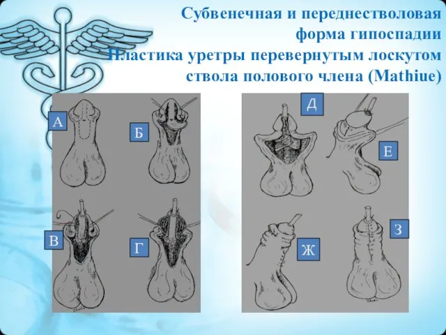 А Б В Г Д Е Ж З Субвенечная и переднестволовая