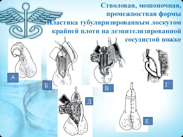 А Г Б В Д Е Стволовая, мошоночная, промежностная формы Пластика