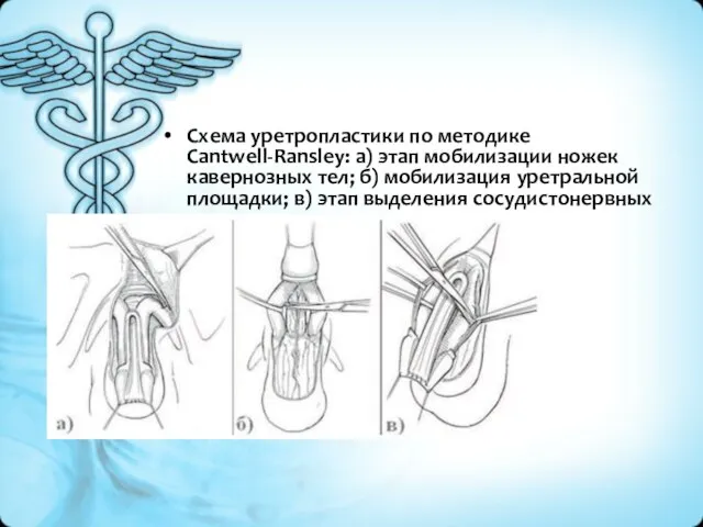 Схема уретропластики по методике Cantwell-Ransley: а) этап мобилизации ножек кавернозных тел;