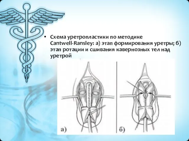 Схема уретропластики по методике Cantwell-Ransley: а) этап формирования уретры; б) этап