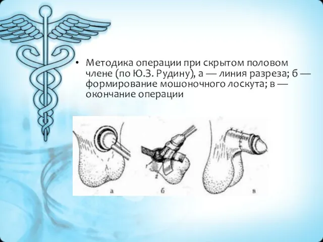 Методика операции при скрытом половом члене (по Ю.З. Рудину), а —