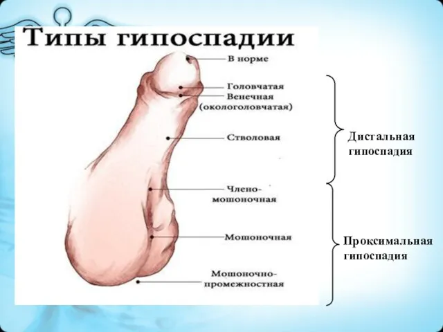 Дистальная гипоспадия Проксимальная гипоспадия