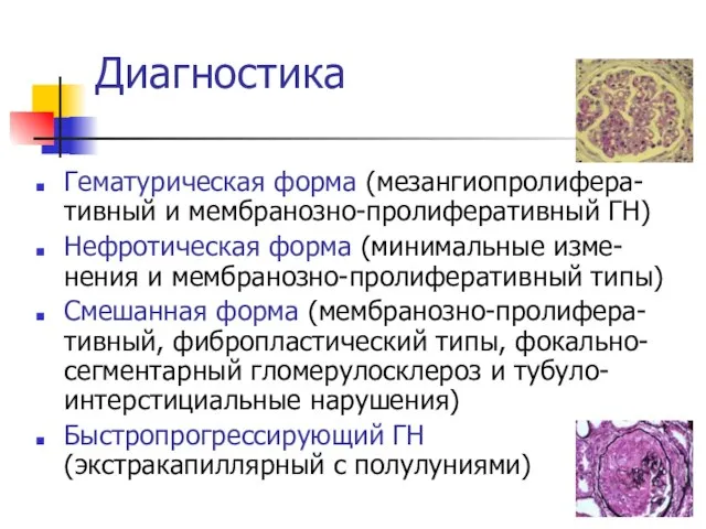 Диагностика Гематурическая форма (мезангиопролифера-тивный и мембранозно-пролиферативный ГН) Нефротическая форма (минимальные изме-нения