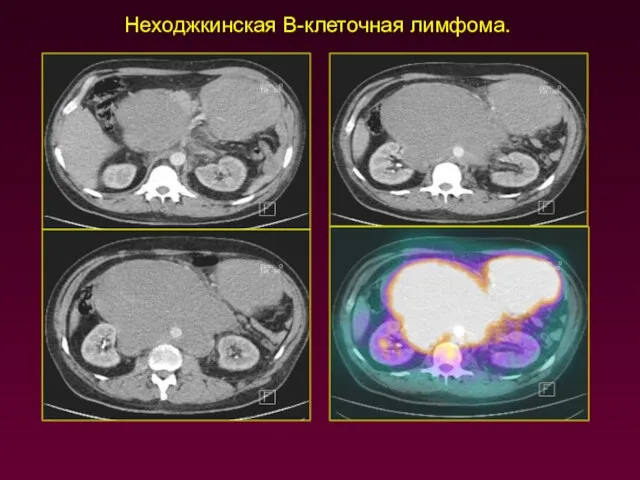 Неходжкинская В-клеточная лимфома.