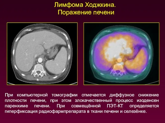 Лимфома Ходжкина. Поражение печени При компьютерной томографии отмечается диффузное снижение плотности