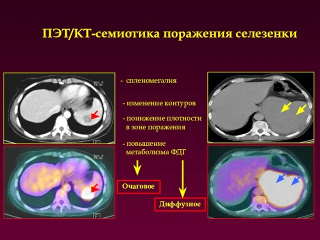 ПЭТ/КТ-семиотика поражения селезенки Очаговое Диффузное - понижение плотности в зоне поражения