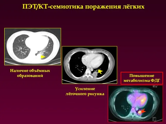 ПЭТ/КТ-семиотика поражения лёгких Наличие объёмных образований Усиление лёгочного рисунка Повышение метаболизма ФДГ