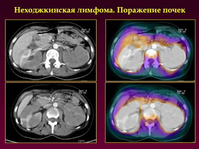 Неходжкинская лимфома. Поражение почек