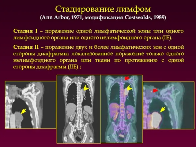 Стадирование лимфом (Ann Arbor, 1971, модификация Costwolds, 1989)