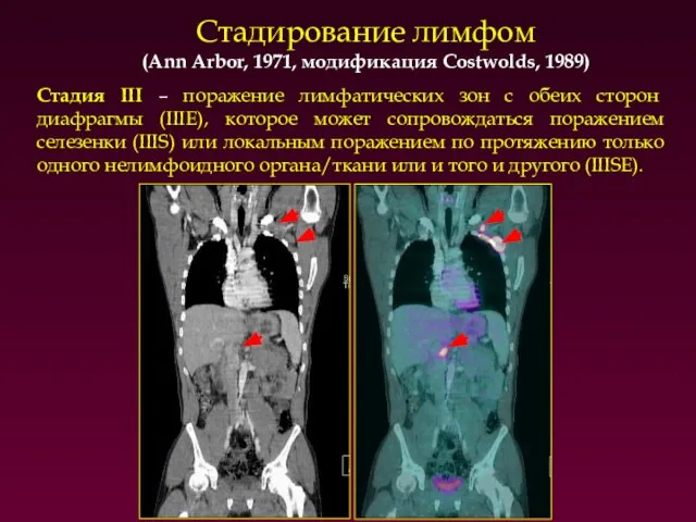 Стадирование лимфом (Ann Arbor, 1971, модификация Costwolds, 1989)