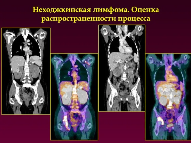 Неходжкинская лимфома. Оценка распространенности процесса