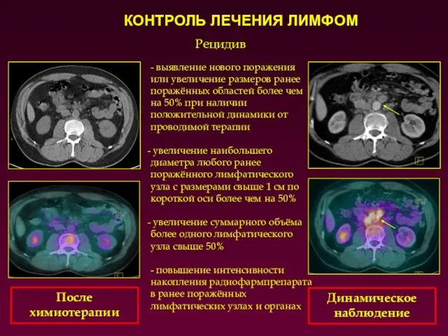 Рецидив - выявление нового поражения или увеличение размеров ранее поражённых областей