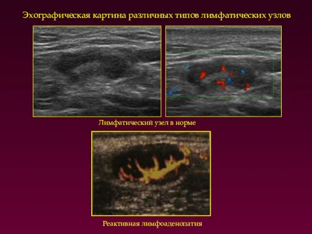 Эхографическая картина различных типов лимфатических узлов Лимфатический узел в норме Реактивная лимфоаденопатия