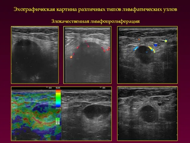 Эхографическая картина различных типов лимфатических узлов Злокачественная лимфопролиферация