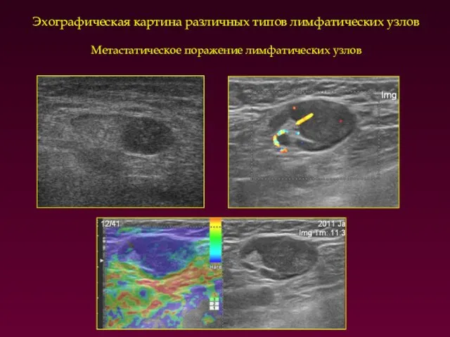 Эхографическая картина различных типов лимфатических узлов Метастатическое поражение лимфатических узлов